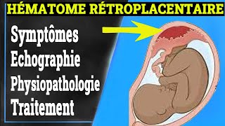 HÉMATOME RÉTROPLACENTAIRE Symptômes Causes Traitement Gynécologie [upl. by Manfred]