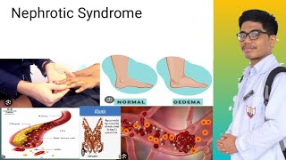 Nephrotic Syndrome  Signs and Symptoms of Nephrotic Syndrome [upl. by Adebayo]