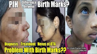 Cause and Treatment of blue Birth Mark on face and eyesWhat is Nevus of OTATreatment In Hindi [upl. by Baerman]