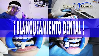 BLANQUEAMIENTO DENTAL ANTES Y DESPUES CLINICA DENTAL VELEZ [upl. by Desberg]