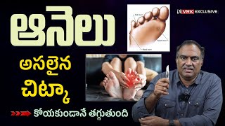 Corn Treatment With VRK Diet  Dr VRK About Corn Removal From Feet at Home  Remove Foot Corns [upl. by Hasseman]