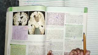 CNS tumors part 3 oligodendrocytoma ependymoma cnspathology robbins pathology [upl. by Inig]