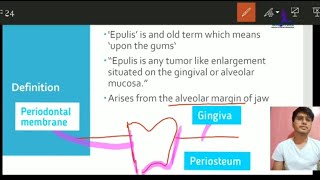 What is Epulis  EASY UNDERSTANDING OF EPULIS  Dentistry  Milestone [upl. by Harbard770]