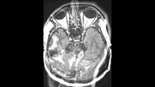 TransverseSigmoid Sinus Venous Thrombosis [upl. by Ffirahs]