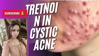 Use of isotretinoin in cystic acne [upl. by Nerro]