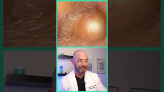 Doctor reacts to juicy cyst pop dermreacts doctorreacts pimplepop [upl. by Ynavoj]