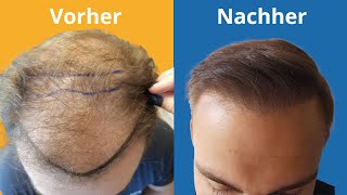 12 Monate nach meiner Haartransplantation  Vorher Nachher [upl. by Linneman]