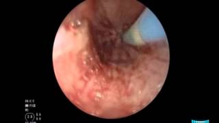 Iatrogenic Perforation of an Advanced Esophageal Carcinoma Placement SelfExpanding Metal Stent [upl. by Nosnek972]