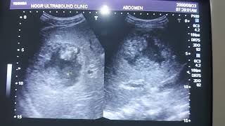 ultrasound liver abscess ultrasound abdomen Hepatic Abscess [upl. by Eojyllib]