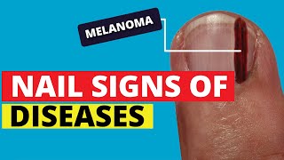 10 Nail Signs of Health Problems Subungual Melanoma Finger Clubbing Nail Pitting Brittle Nails [upl. by Roderich]