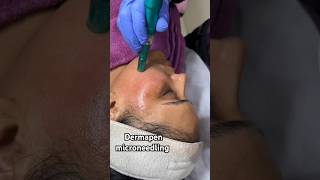 Dermapen microneedling treatment For Brightening skin👍microneedling dermapen skincare [upl. by Ailecec703]