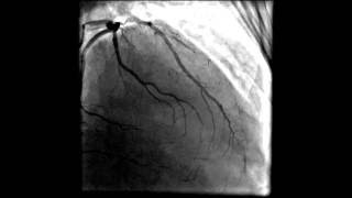 Heart angiogram coronary and three vessel disease [upl. by Adlihtam534]