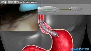 HANAROSTENT® Esophagus Valve  Product Introduction and procedure Gastroenterology [upl. by Giffie]