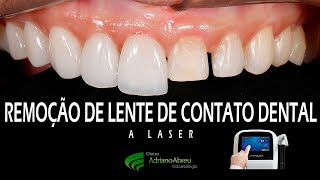 Remoção de lentes de contato dental a laser  Fortaleza  CE [upl. by Eaner2]