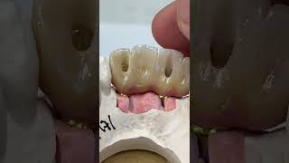 Two implants with 4 unit Hygiene ceramics [upl. by Ayama]