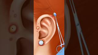 ASMR ear piercing removal Treatment clean ear piercing amp pus 2d animation [upl. by Ahsilif]