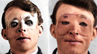 The Tragic History of WW1 Plastic Surgery [upl. by Nanreh507]