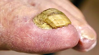 Super THICK BIG TOENAIL Trimming NAIL FUNGUS OR DAMAGED TOENAIL [upl. by Keane]