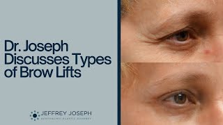 Different Types of Brow Lifts Explained  Which Brow Lift Technique is Right for You [upl. by Annirak85]