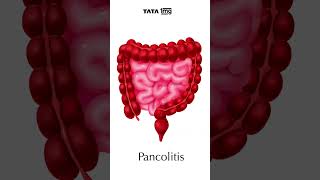 TYPES OF ULCERATIVE COLITIS आईबीडी का एक प्रकार tata1mg inflammatoryboweldiseases [upl. by Nies620]