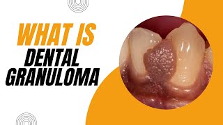 What is Dental Granuloma Causes Symptoms and Treatment [upl. by Nynahs829]