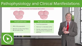 Calcific Aortic Stenosis  Pathophysiology and Clinical Manifestations [upl. by Vaclav667]