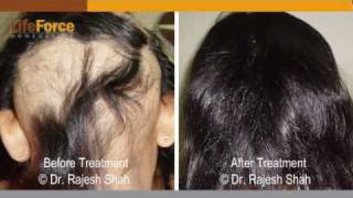 Horrible Hair Loss amp Large Patches of Alopecia Areata Case Treated at Life Force [upl. by Arul]