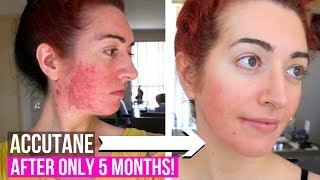 Accutane Side Effects  Mental Health Questions  Month 5 Update  Jess Bunty [upl. by Proud346]