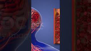 Artherosclerosis  Cholesterol deposition in the blood vessels [upl. by Orji]