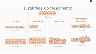 Displasia e Neoplasia  Colo uterino  Descrição histo e citopatológicos [upl. by Iggam958]