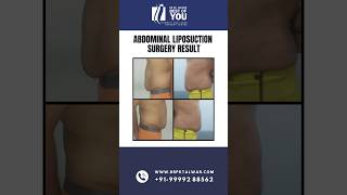 Abdominal Liposuction Surgery BeforeAfter Results  Liposuction Surgeon In Delhi  Dr PK Talwar [upl. by Erdnael]