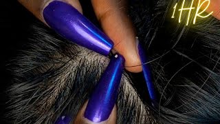 ASMR 1 HR Super Attentive NITPICKING SCALP WHITEHEADS  soft spoken  zoomed [upl. by Raddatz816]