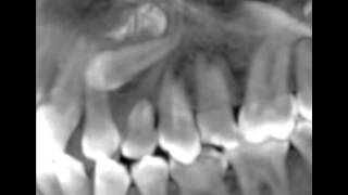 Canines incluses CBCT scan impacted cuspids orthodontie 123213 IT31 [upl. by Peers721]