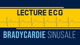 Interprétation ECG  Bradycardie Sinusale [upl. by Nilpik809]