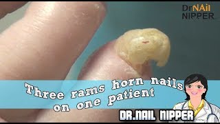 Three Rams Horn Nails on One Patient Do you have one toenail 2018 [upl. by Einial]