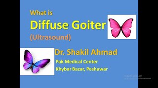 What is Diffuse Goiter Ultrasound features [upl. by Accem]