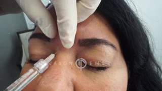 Belotero Forehead Lines and Wrinkles  Soft Tissue Filler Merz Aesthetics  Los Angeles [upl. by Aneerehs]