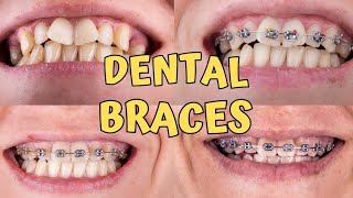 Braces time lapse  Teeth braces treatment  braces teeth transformation [upl. by Liahus]