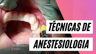 Técnicas de anestesiologia local utilizadas na Odontologia  Semente Leão  Dra Tuanny Lima [upl. by Hamner]