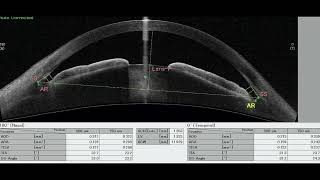 Indentation gonioscopy​ [upl. by Eiznil]