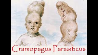 Craniopagus Parasiticus – a parasitic head protruding from temporal area of cranium [upl. by Silrac]