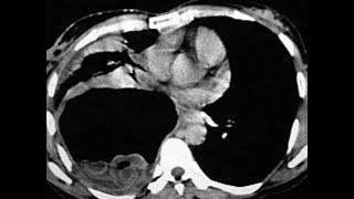 CT CHEST V24 SPN MASS AND HYDATID CYST respiratorymedicine lungs radiology doctor biology [upl. by Anilehs]