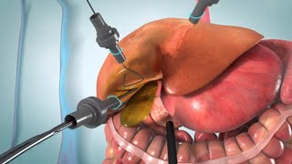 Laparoscopic and open cholecystectomy surgery animation [upl. by Anitsirhc]