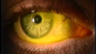 Instilling Fluorescein Dye in the Eye [upl. by Aihsoek915]