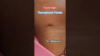 Hood Sign of Thyroglossal Fistula [upl. by Attenal]