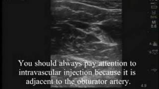 UltrasoundGuided Obturator Nerve Block [upl. by Moses711]