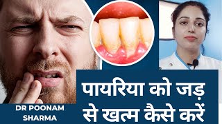 पायरिया को जड़ से खत्म करने का इलाज  Pyorrhea Treatment Pyorrhea Ko Jad Se Khatam Karne ka Ilaj [upl. by Bosson]