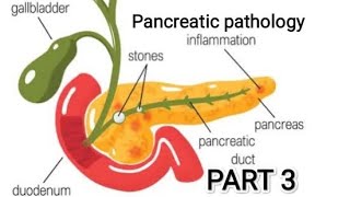 Pancreas pathology  acute pancreatitis pathology pancreas git [upl. by Rubma]