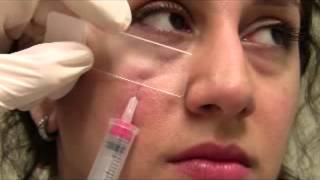 Acne Papule Injection [upl. by Ecnerol]