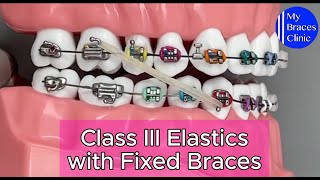 How to wear Class III Elastics with Fixed Braces [upl. by Cherrita]